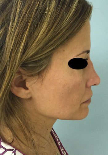 After Image: Rhinoplasty - right-side