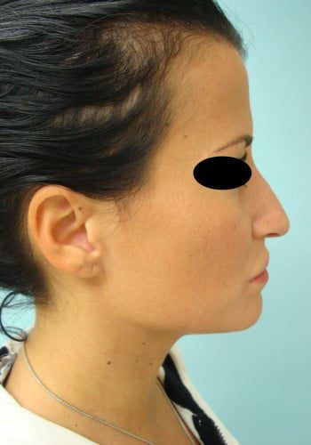Before Image: Rhinoplasty - right-side