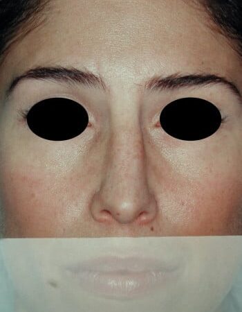 After Image: Rhinoplasty - front