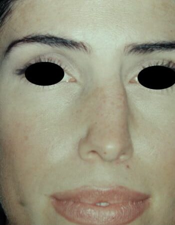 Before Image: Rhinoplasty - front