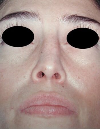 After Image: Rhinoplasty - front