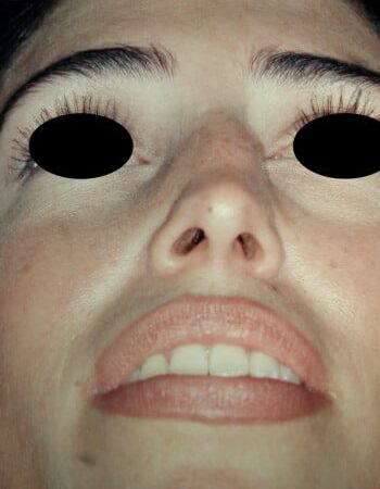 Before Image: Rhinoplasty - front