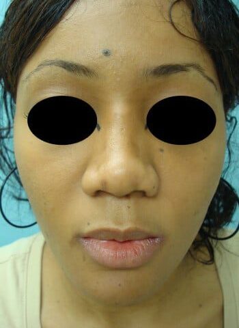 After Image: Rhinoplasty - front