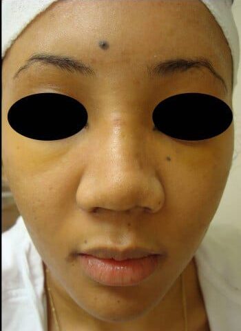 Before Image: Rhinoplasty - front