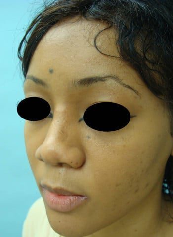 After Image: Rhinoplasty - left-front-oblique