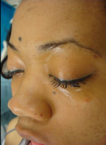 Before Image: Rhinoplasty - left-front-oblique