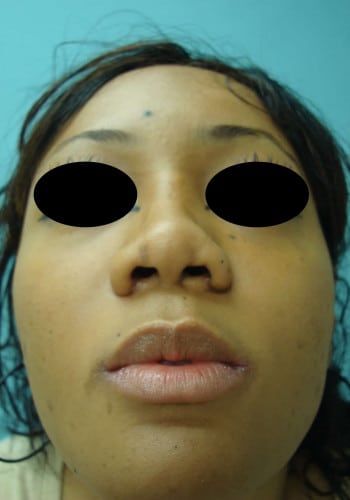 After Image: Rhinoplasty - front