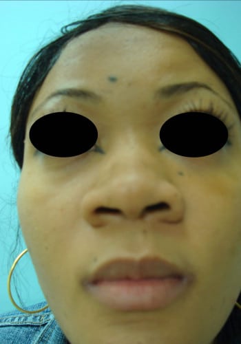 Before Image: Rhinoplasty - front