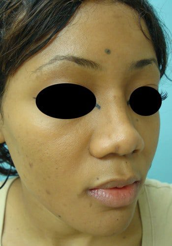 After Image: Rhinoplasty - right-front-oblique