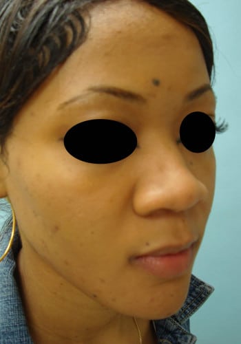 Before Image: Rhinoplasty - right-front-oblique