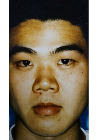 Before Image: Facial Feminization - front