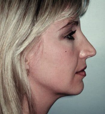 After Image: Rhinoplasty - right-side