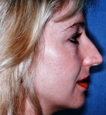 Before Image: Rhinoplasty - right-side