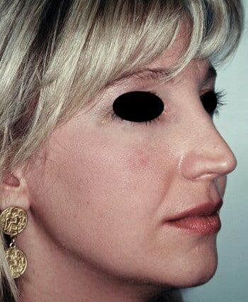 After Image: Rhinoplasty - right-front-oblique