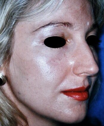 Before Image: Rhinoplasty - right-front-oblique