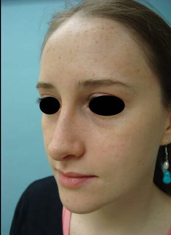 After Image: Rhinoplasty - left-front-oblique
