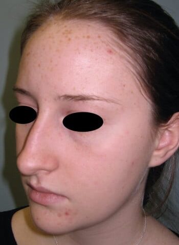 Before Image: Rhinoplasty - left-front-oblique