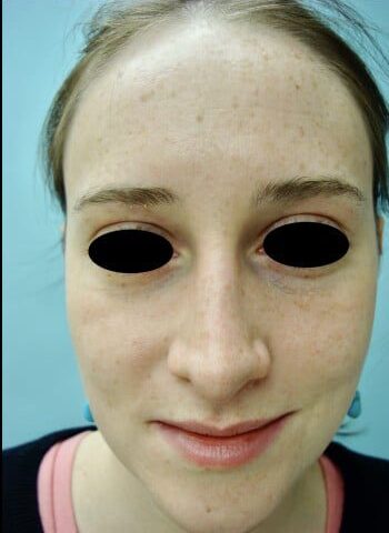 After Image: Rhinoplasty - front
