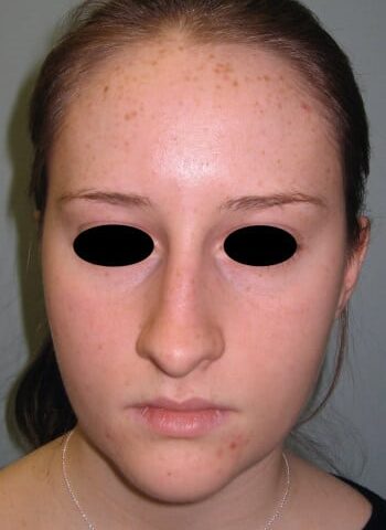 Before Image: Rhinoplasty - front