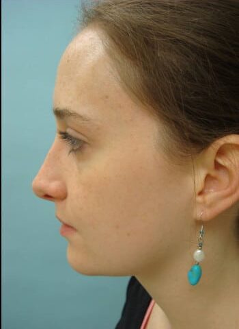After Image: Rhinoplasty - left-side