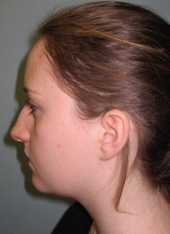 Before Image: Rhinoplasty - left-side