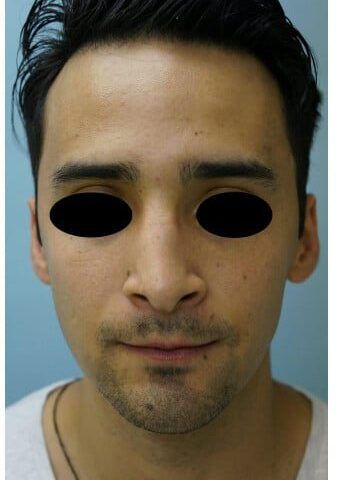 After Image: Rhinoplasty - front