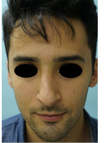 Before Image: Rhinoplasty - front