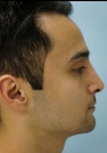 After Image: Rhinoplasty - right-side