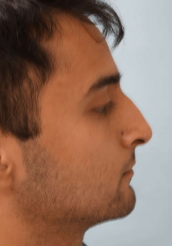Before Image: Rhinoplasty - right-side
