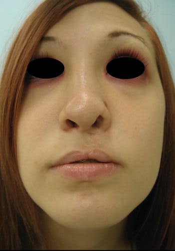 After Image: Cleft Rhinoplasty - front