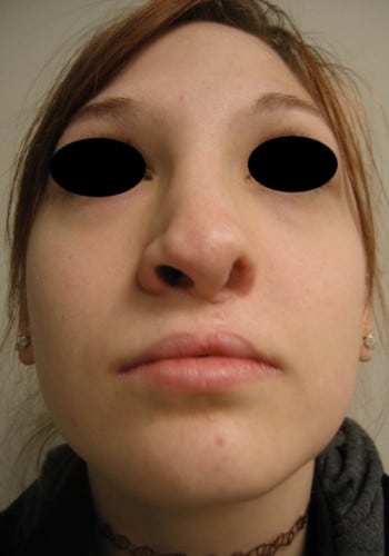 Before Image: Cleft Rhinoplasty - front