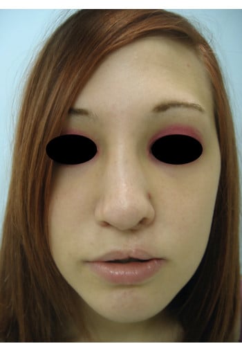 After Image: Cleft Rhinoplasty - front