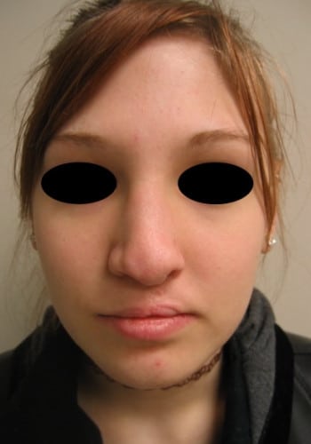 Before Image: Cleft Rhinoplasty - front