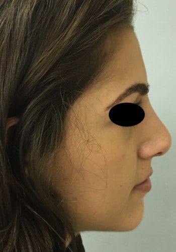 After Image: Rhinoplasty - right-side