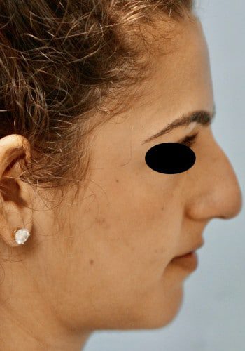 Before Image: Rhinoplasty - right-side