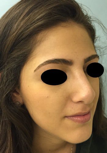 After Image: Rhinoplasty - right-front-oblique