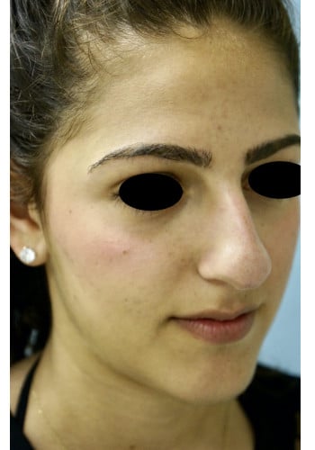 Before Image: Rhinoplasty - right-front-oblique