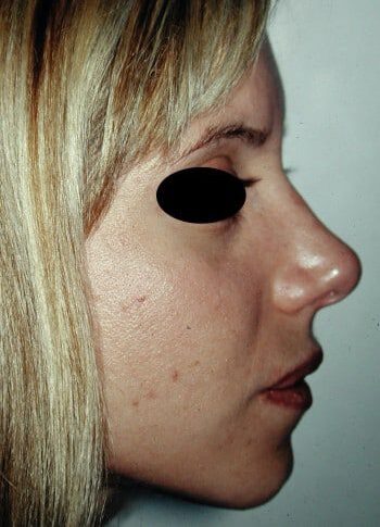After Image: Rhinoplasty - right-side