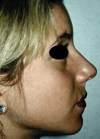 Before Image: Rhinoplasty - right-side