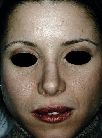 After Image: Rhinoplasty - front