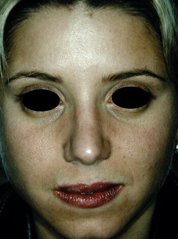 Before Image: Rhinoplasty - front