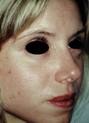After Image: Rhinoplasty - right-front-oblique
