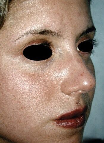 Before Image: Rhinoplasty - right-front-oblique