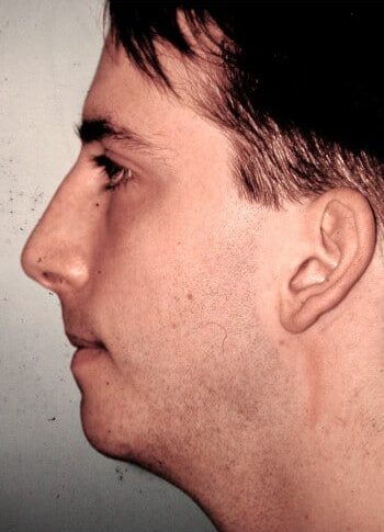 After Image: Genioplasty - left-side