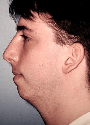 Before Image: Genioplasty - left-side
