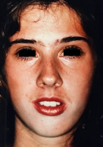 Before Image: Genioplasty, Rhinoplasty, Le Fort I - front