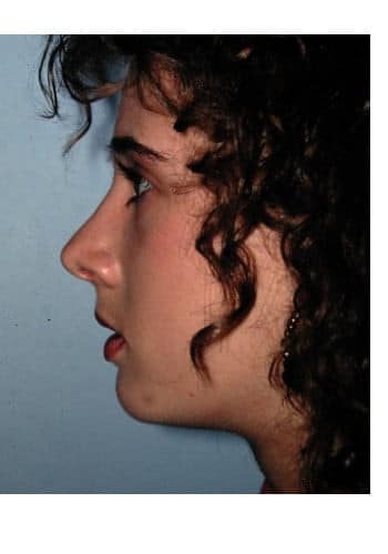 After Image: Genioplasty, Rhinoplasty, Le Fort I - left-side