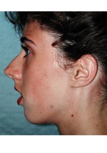 Before Image: Genioplasty, Rhinoplasty, Le Fort I - left-side