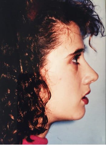 After Image: Genioplasty, Rhinoplasty, Le Fort I - right-side