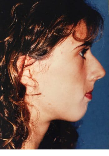 Before Image: Genioplasty, Rhinoplasty, Le Fort I - right-side